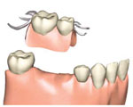 部分入れ歯