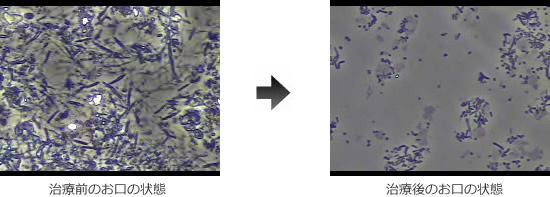 治療前後での細菌数の比較
