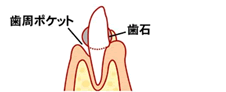 歯周炎1