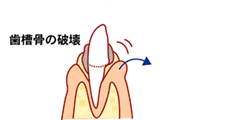 歯周炎1