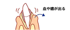 歯が抜ける