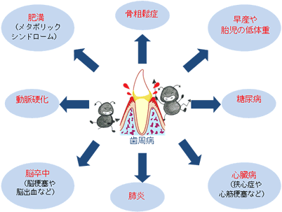 歯周病と深く関係する体の病気