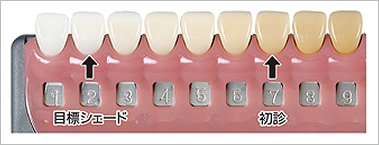 初診と目標の白さの色調調査比較