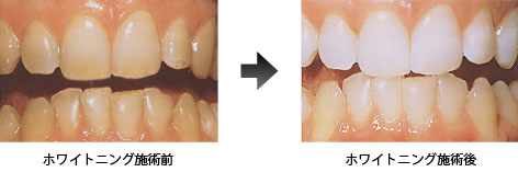 ホワイトニング術前・術後画像